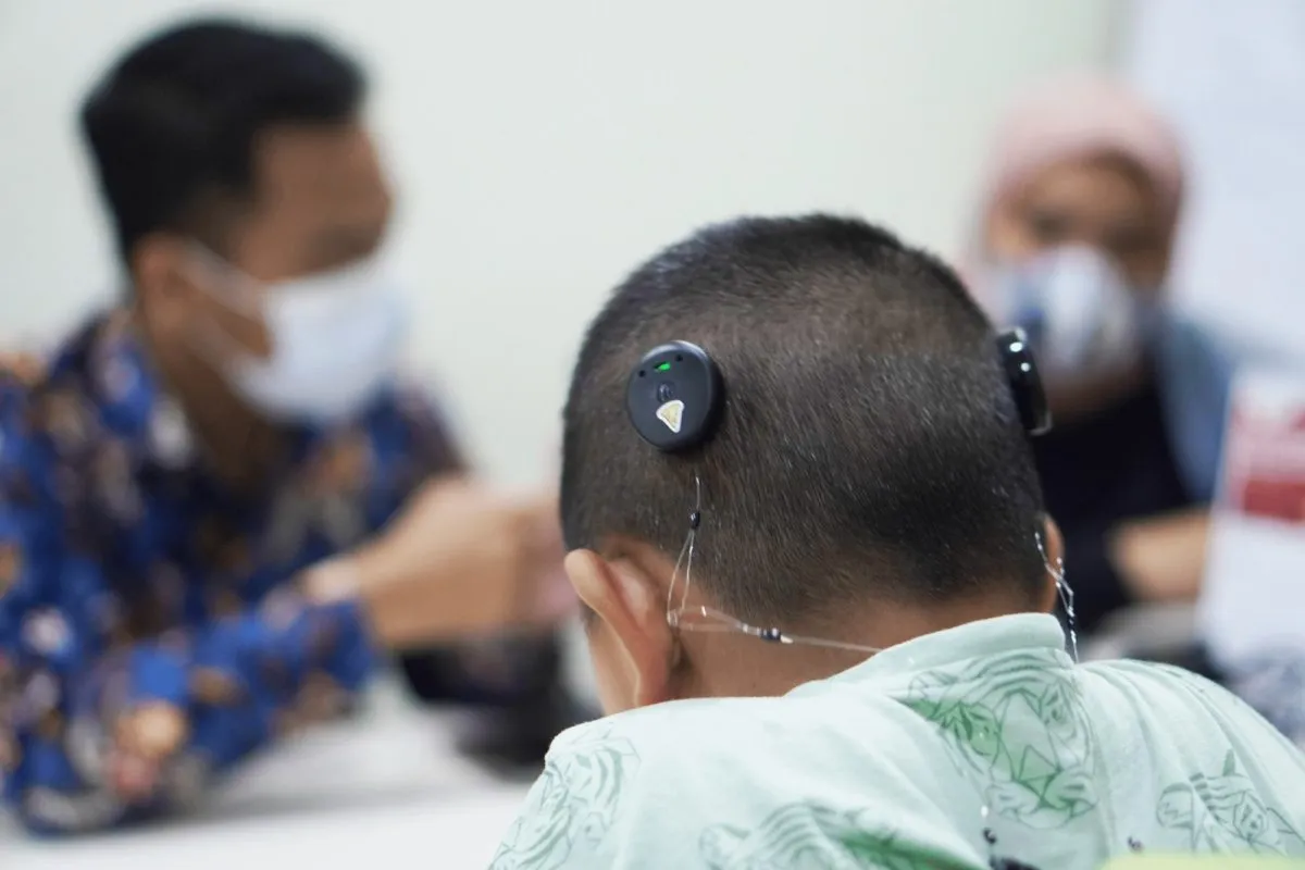 Pentingnya Mapping Rutin untuk Pengguna Cochlear Implant
